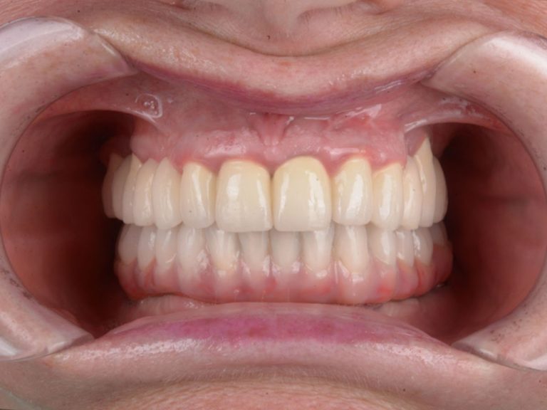 Reabilitare orală mixtă: lucrare pe dinți naturali și implanturi