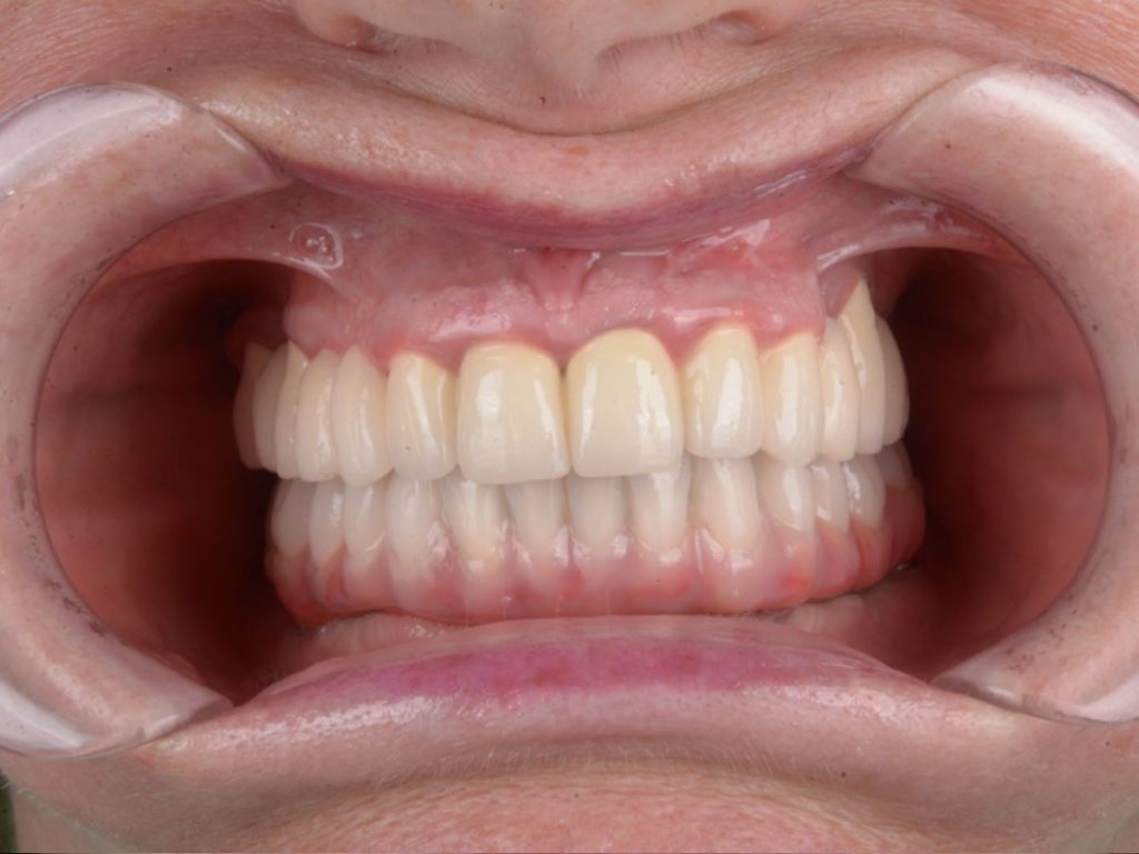 Reabilitare orală mixtă: lucrare pe dinți naturali și implanturi