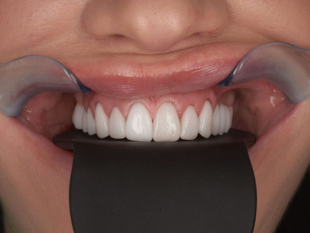 Reabilitare totală estetică și funcțională – maxilar și mandibulă