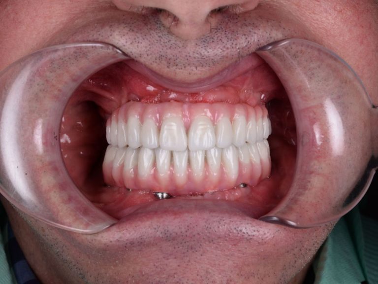 Reabilitare totală estetică și funcțională prin sistemul All-on-X