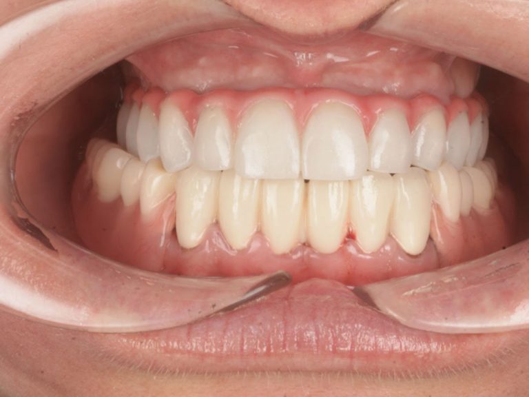 Reabilitare totală estetică și funcțională – maxilar și mandibulă finalizate în aceeași etapă