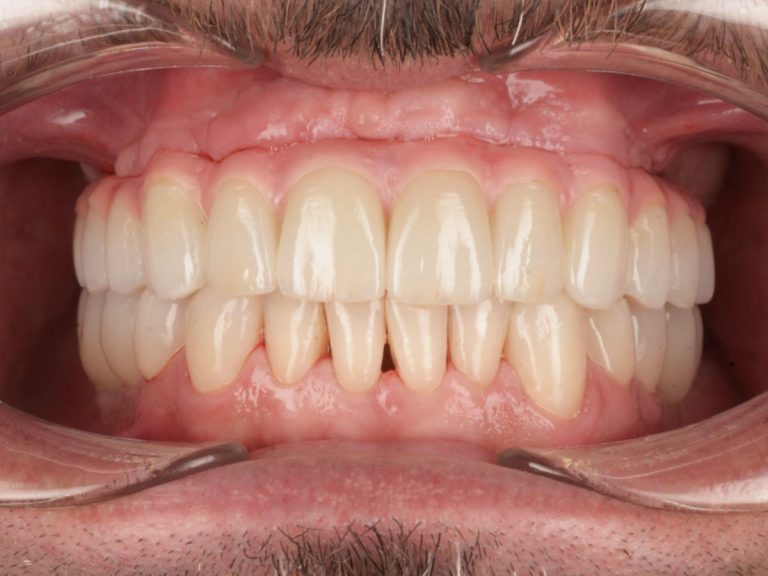 Reabilitare estetică și funcțională completă – maxilar și mandibulă