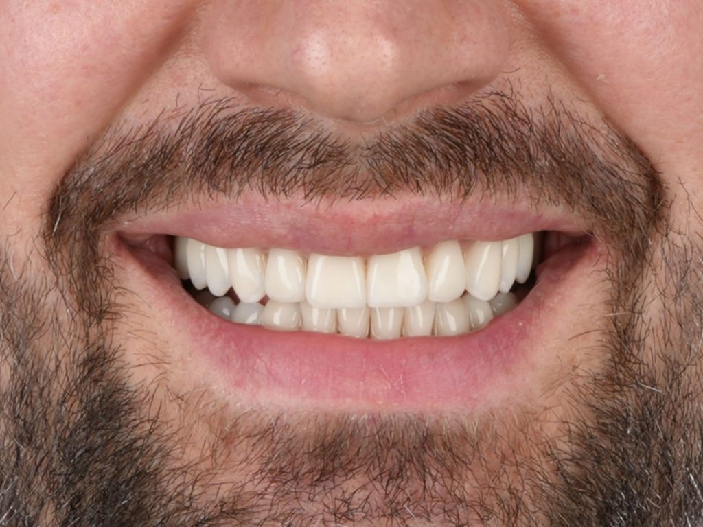 Reabilitare estetică și funcțională completă – maxilar și mandibulă