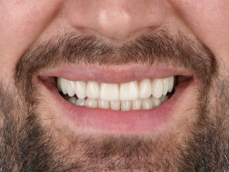 Reabilitare estetică și funcțională completă – maxilar și mandibulă