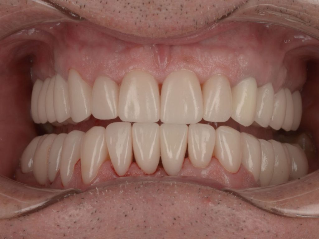 Reabilitare totală estetică și funcțională