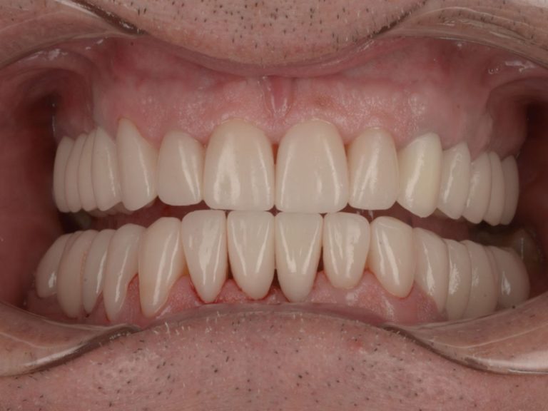 Reabilitare totală estetică și funcțională