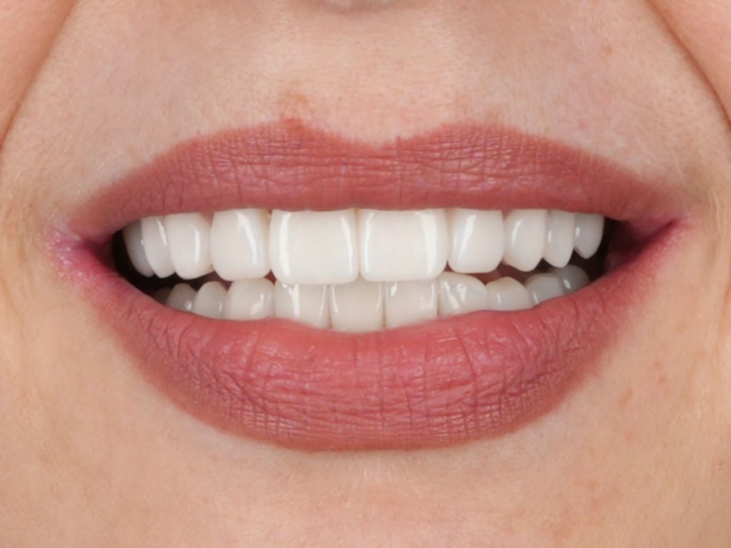 Reabilitare totală estetică și funcțională – maxilar și mandibulă