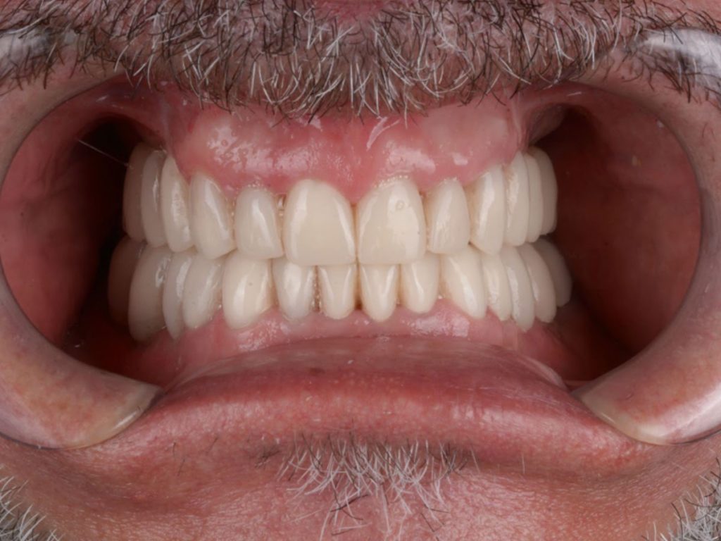 Reabilitare totală estetică și funcțională – fațete, coroane, implanturi existente
