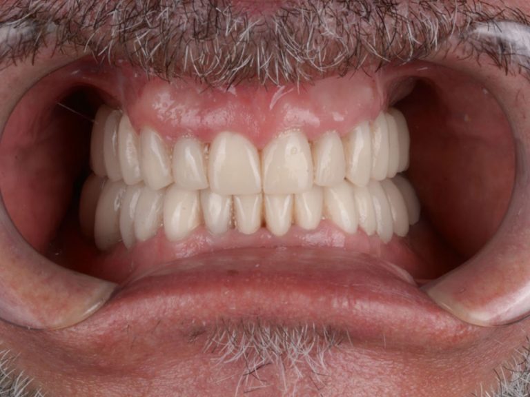 Reabilitare totală estetică și funcțională – fațete, coroane, implanturi existente